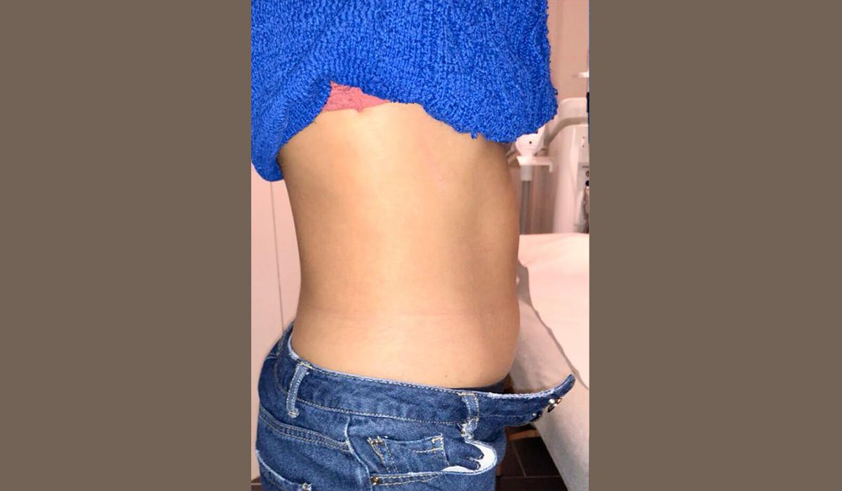 apres lipocavitation