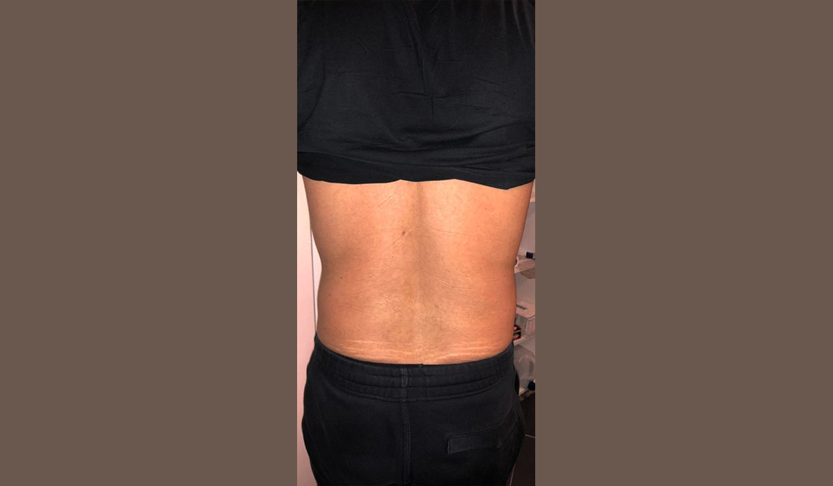 lipocavitation radiofréquence après