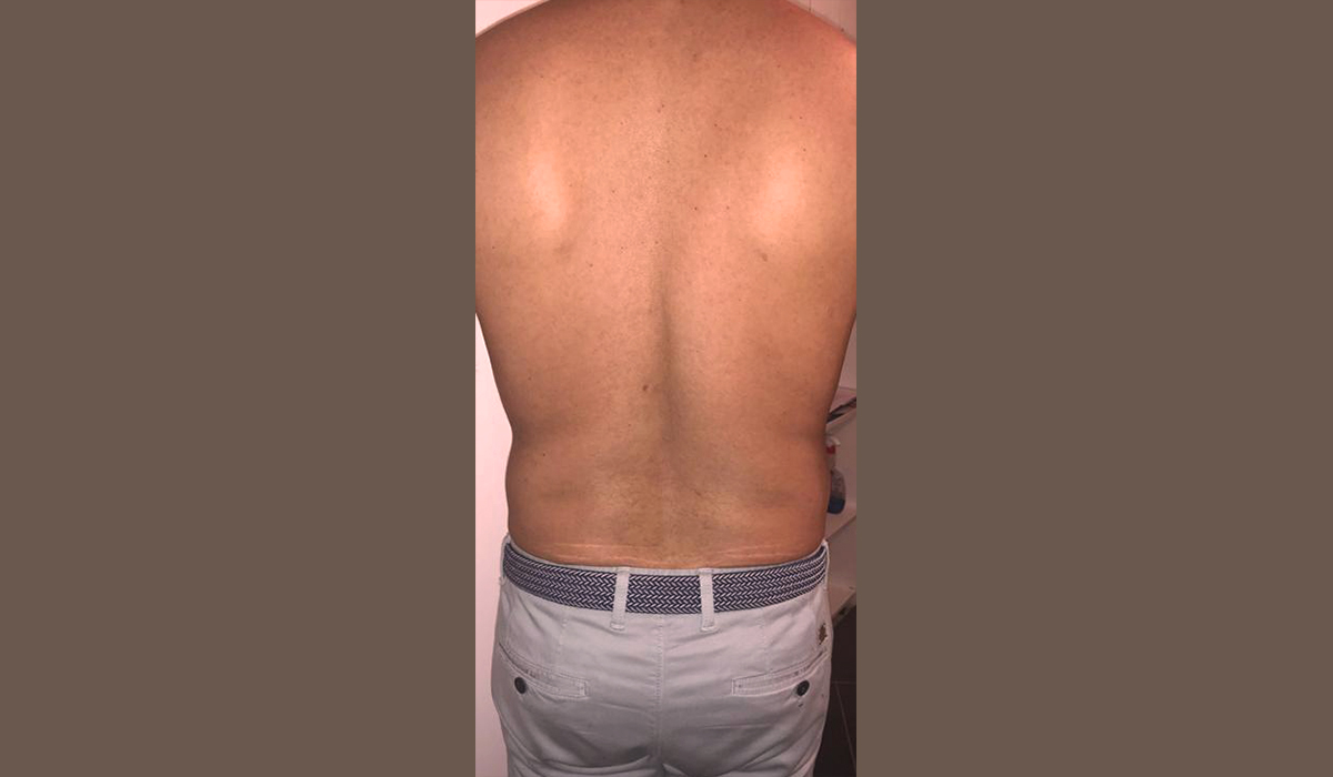 lipocavitation radiofréquence avant