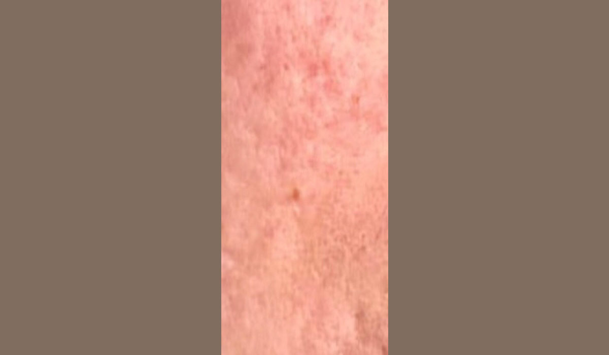 apres microneedling visage