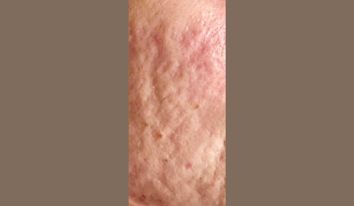 avant microneedling visage