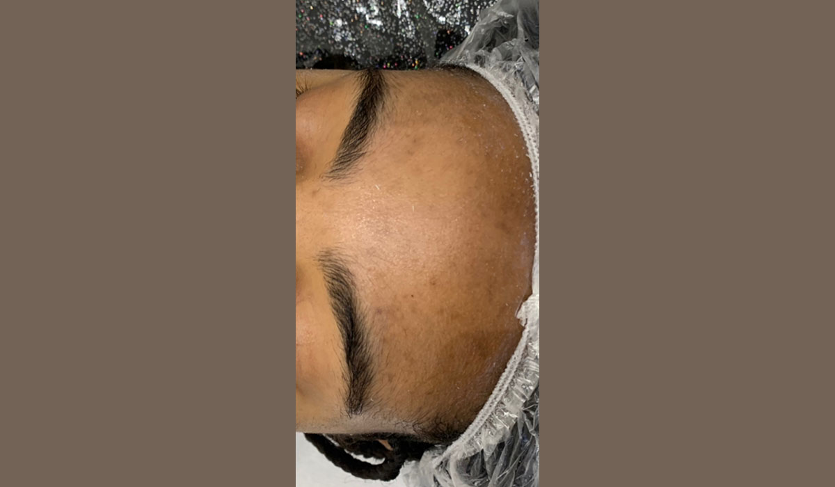 microdermabrasion-apres-cocoonin