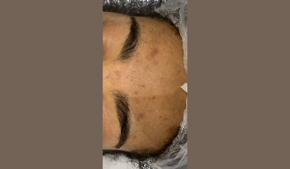 microdermabrasion-avant-cocoonin