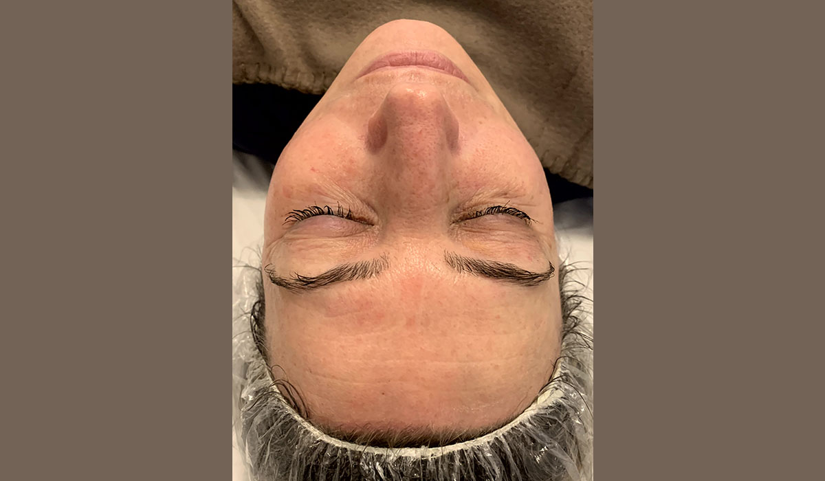 radiofrequence-visage-apres-cocoonin