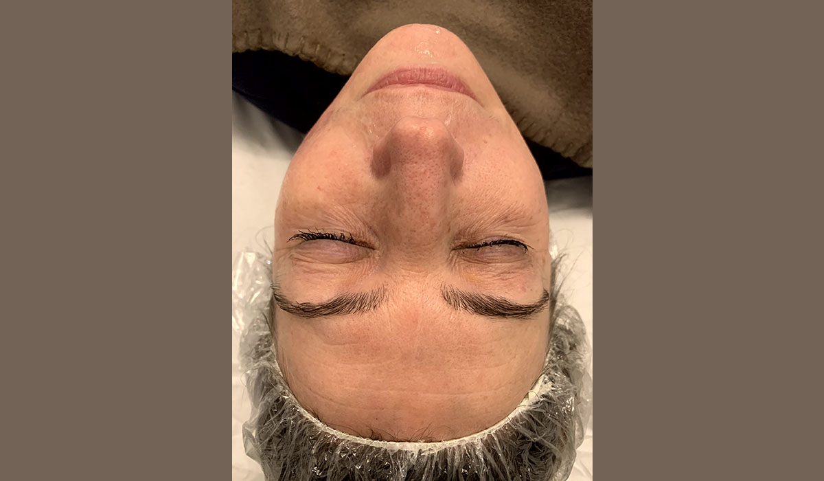 radiofrequence-visage-avant-cocoonin